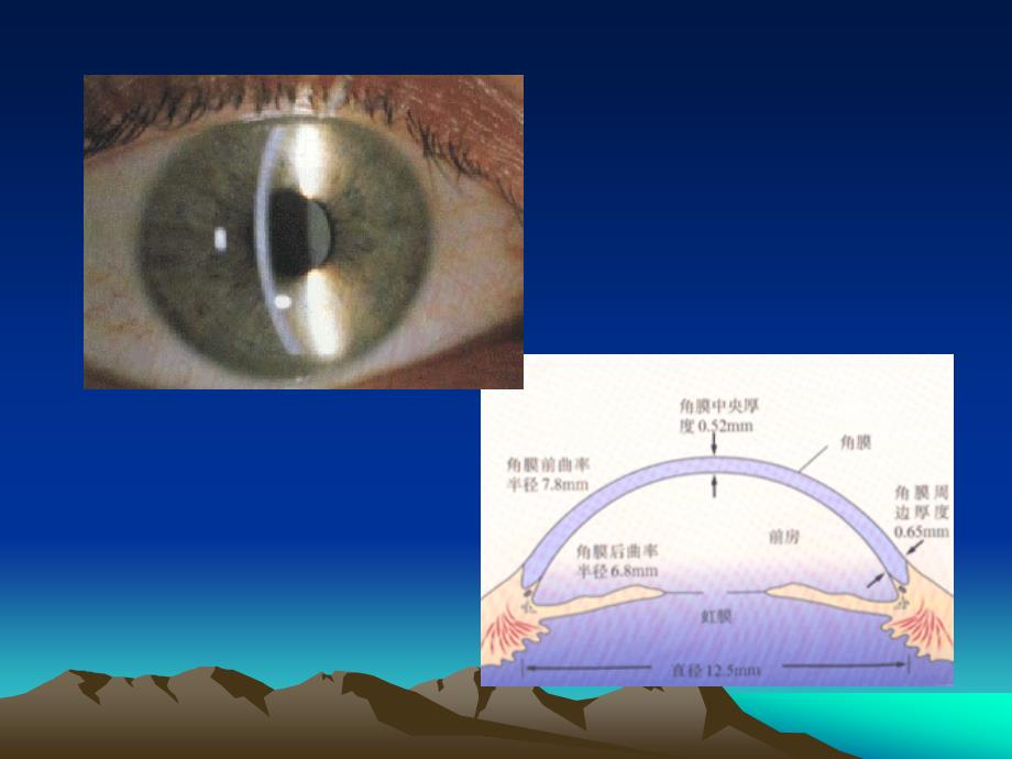 角膜疾病英文课件_第3页