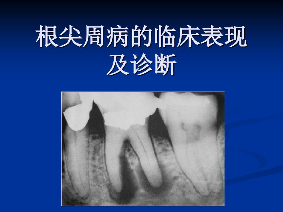 根尖周病的临床表现及诊断_第1页