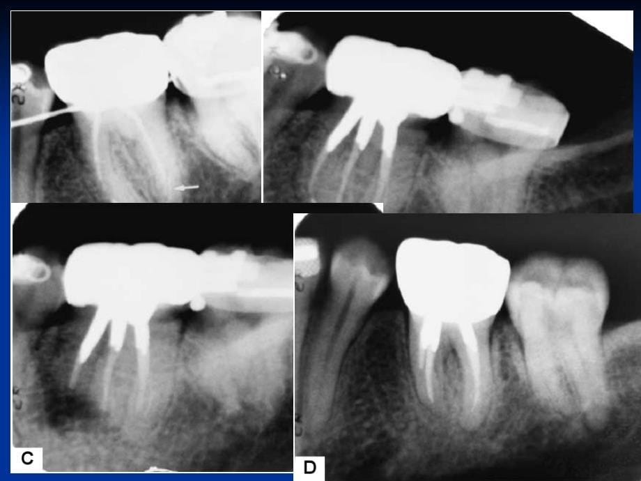 根尖周病的临床表现及诊断_第5页