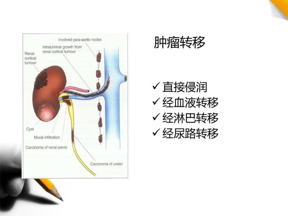 泌外肿瘤医学课件_第5页