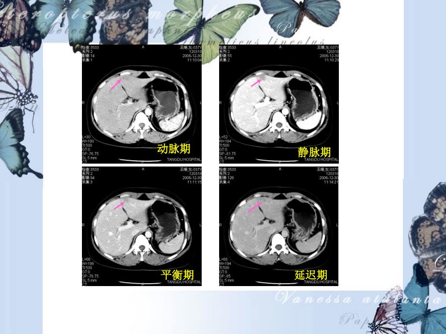 肝脏镰状韧带旁假病灶_第1页