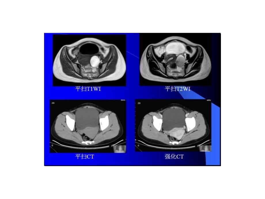 盆腔病变的mri诊断_第4页