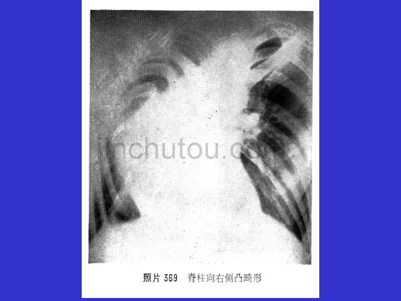 慢性肺原性心脏病_第5页