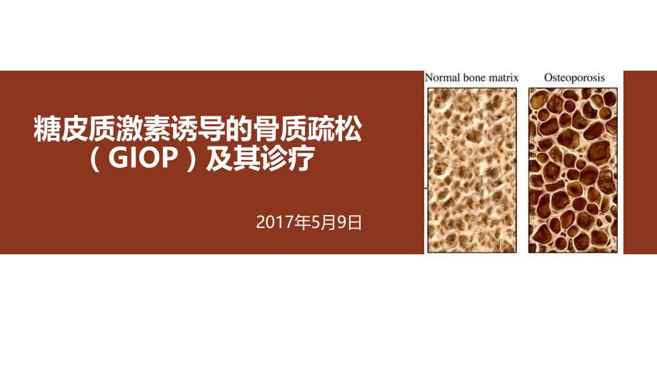 糖皮质激素诱导的骨质疏松_第1页