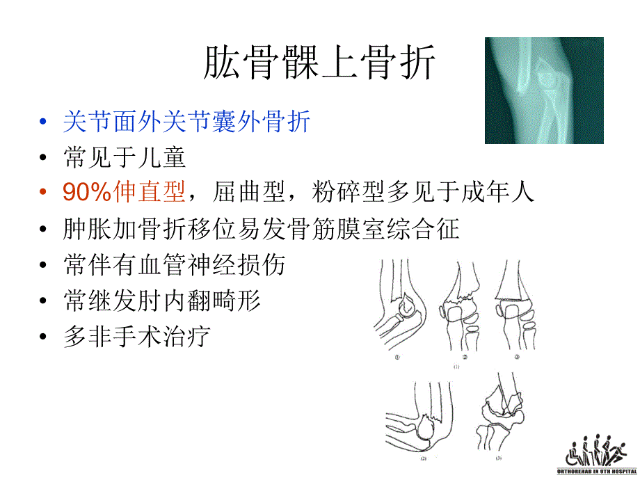 肘关节骨折康复治疗_第4页