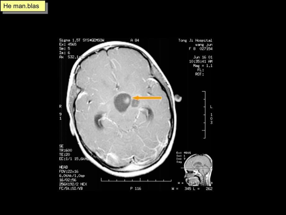 颅内环形占位性病变的影像学_第5页