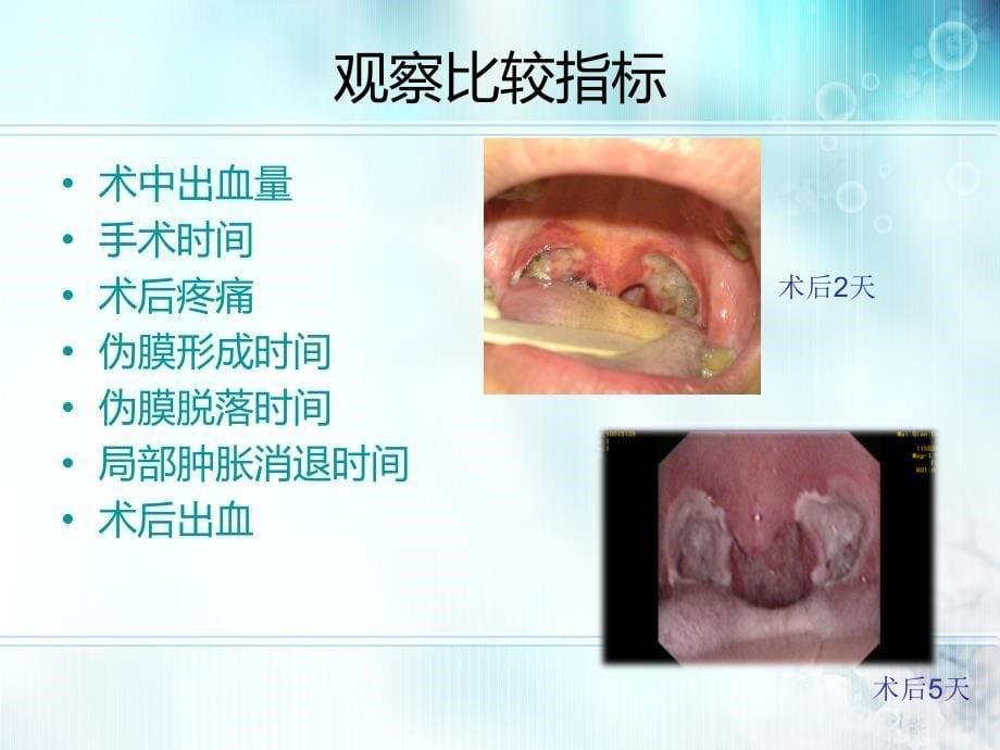 超声刀在扁桃体切除手术中的应用_第5页