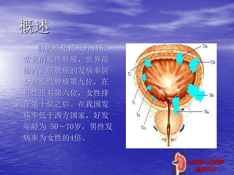 膀胱癌术后膀胱灌注的护理_第2页