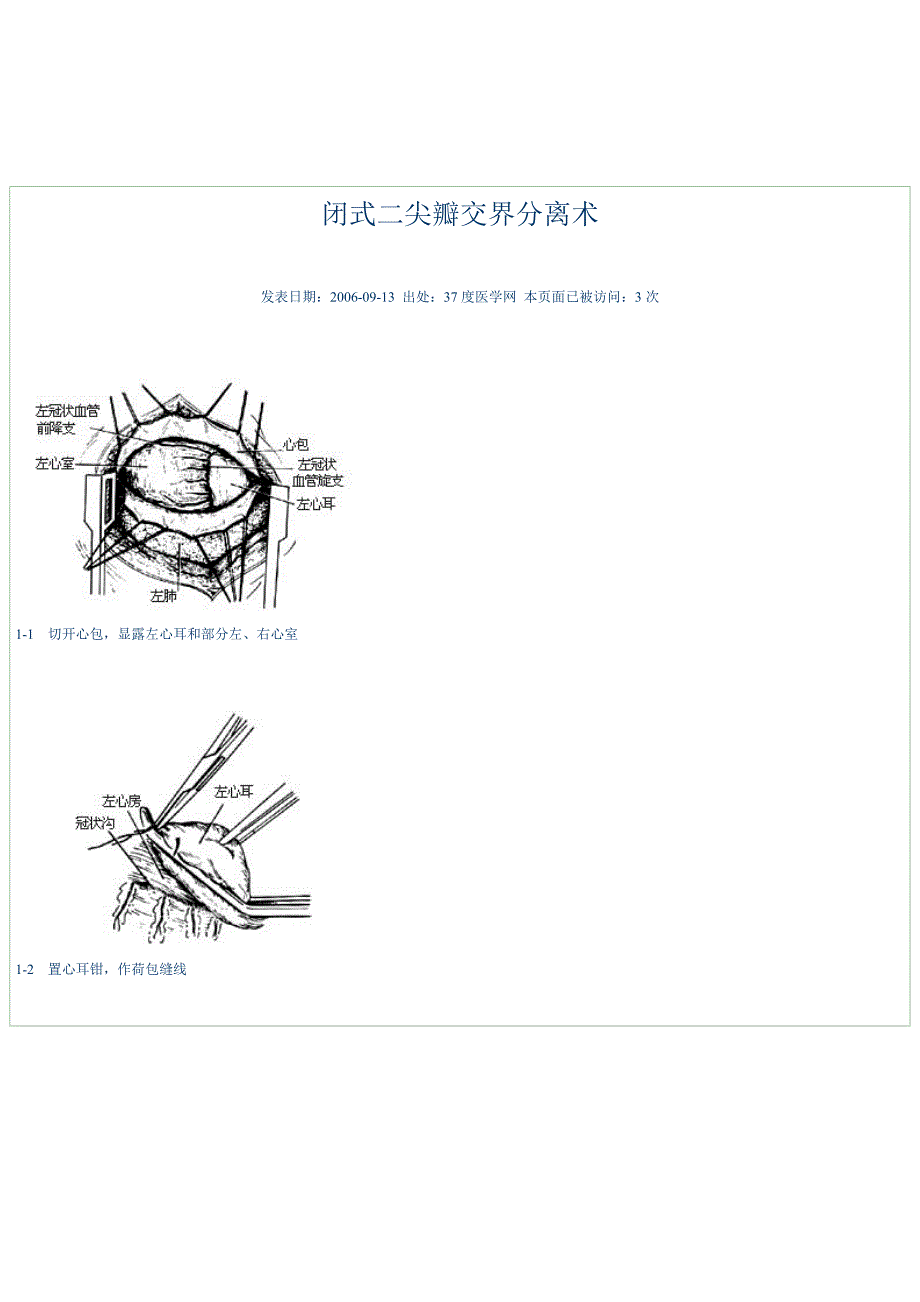 闭式二尖瓣交界分离术_第1页