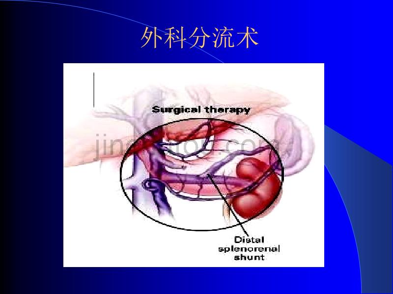 3.(沈云志)危重食管静脉曲张破裂大出血急诊硬化_第4页