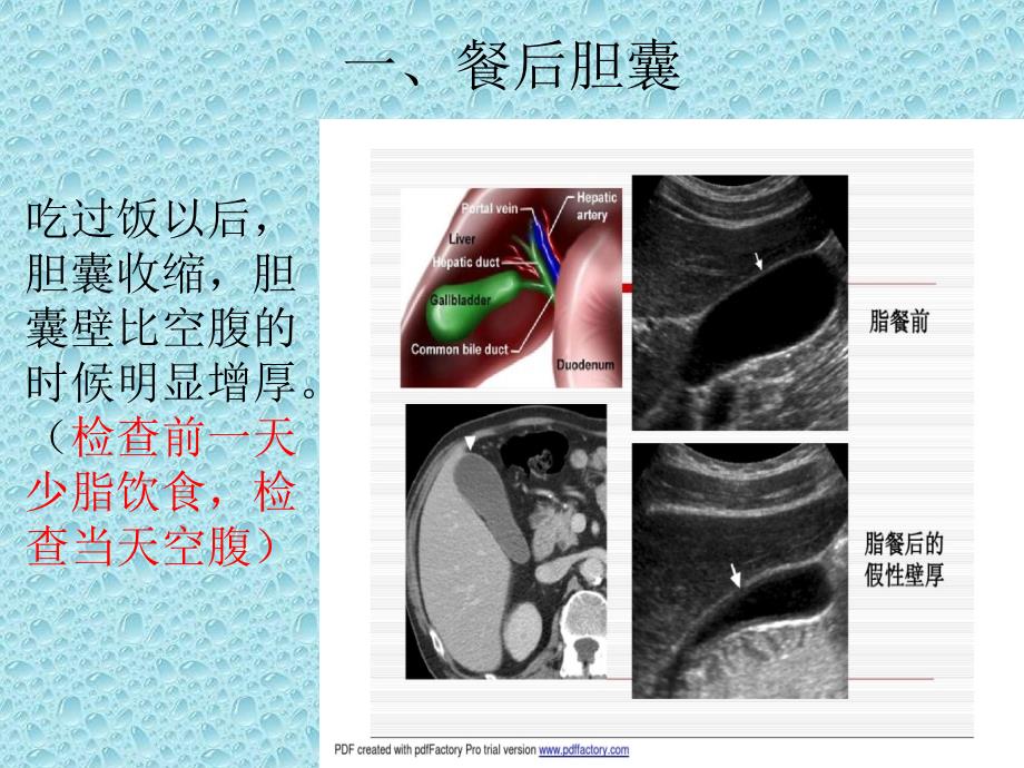 胆囊壁增厚影像诊断_第4页