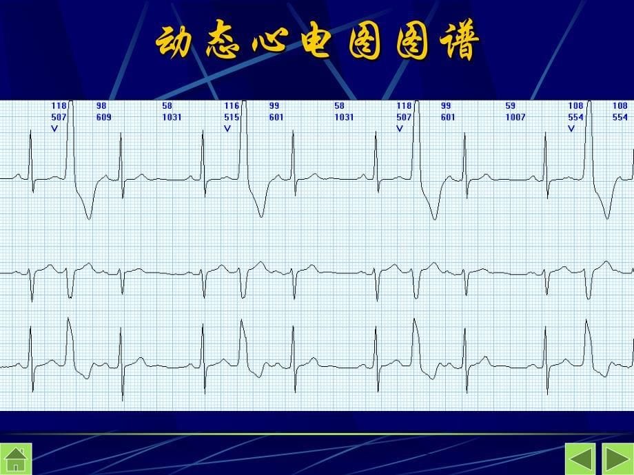 动态心电图诊断标准_第5页