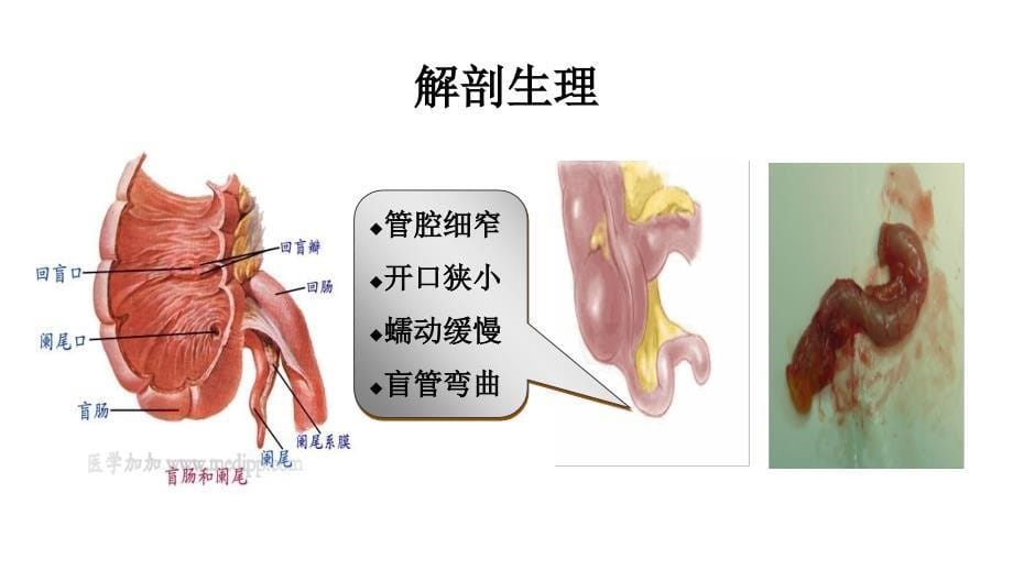 急性阑尾炎病人的护理_第5页