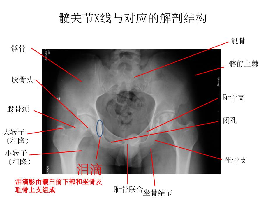 全髋关节置换术中的精确重建_第2页