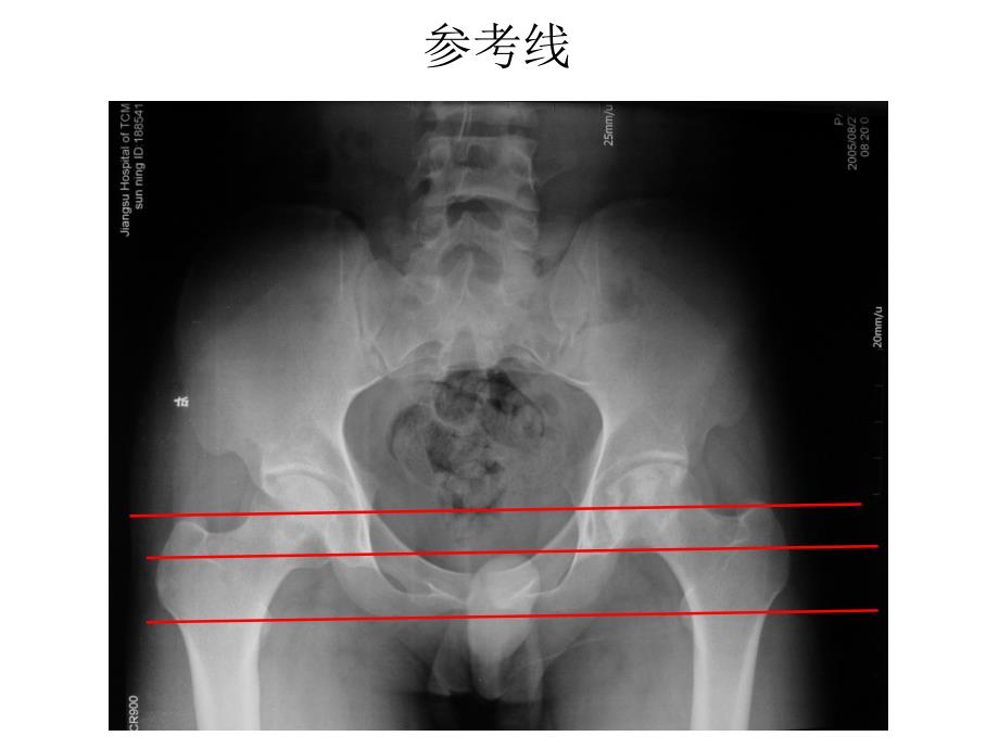 全髋关节置换术中的精确重建_第4页