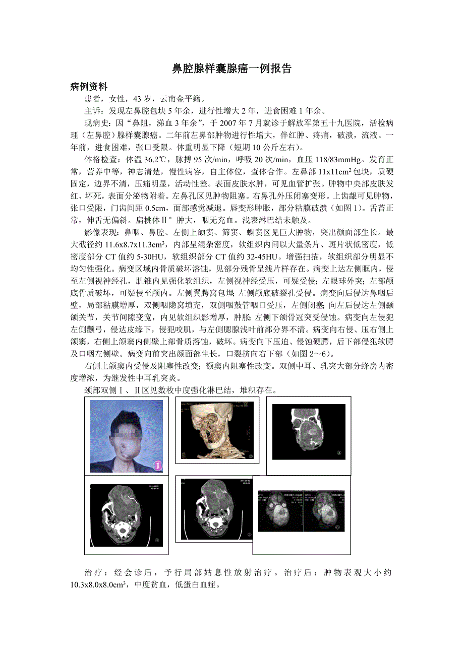 鼻腔腺样囊腺癌一例报告_第1页