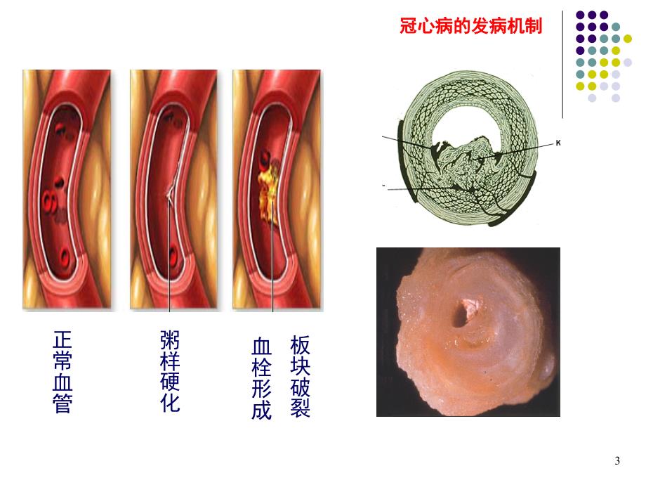 冠状动脉造影术的护理_第4页