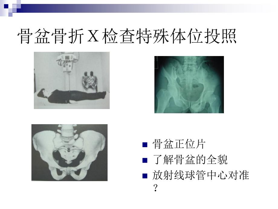 骨盆骨折x检查特殊体位投照_第3页