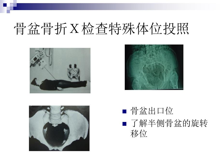 骨盆骨折x检查特殊体位投照_第4页