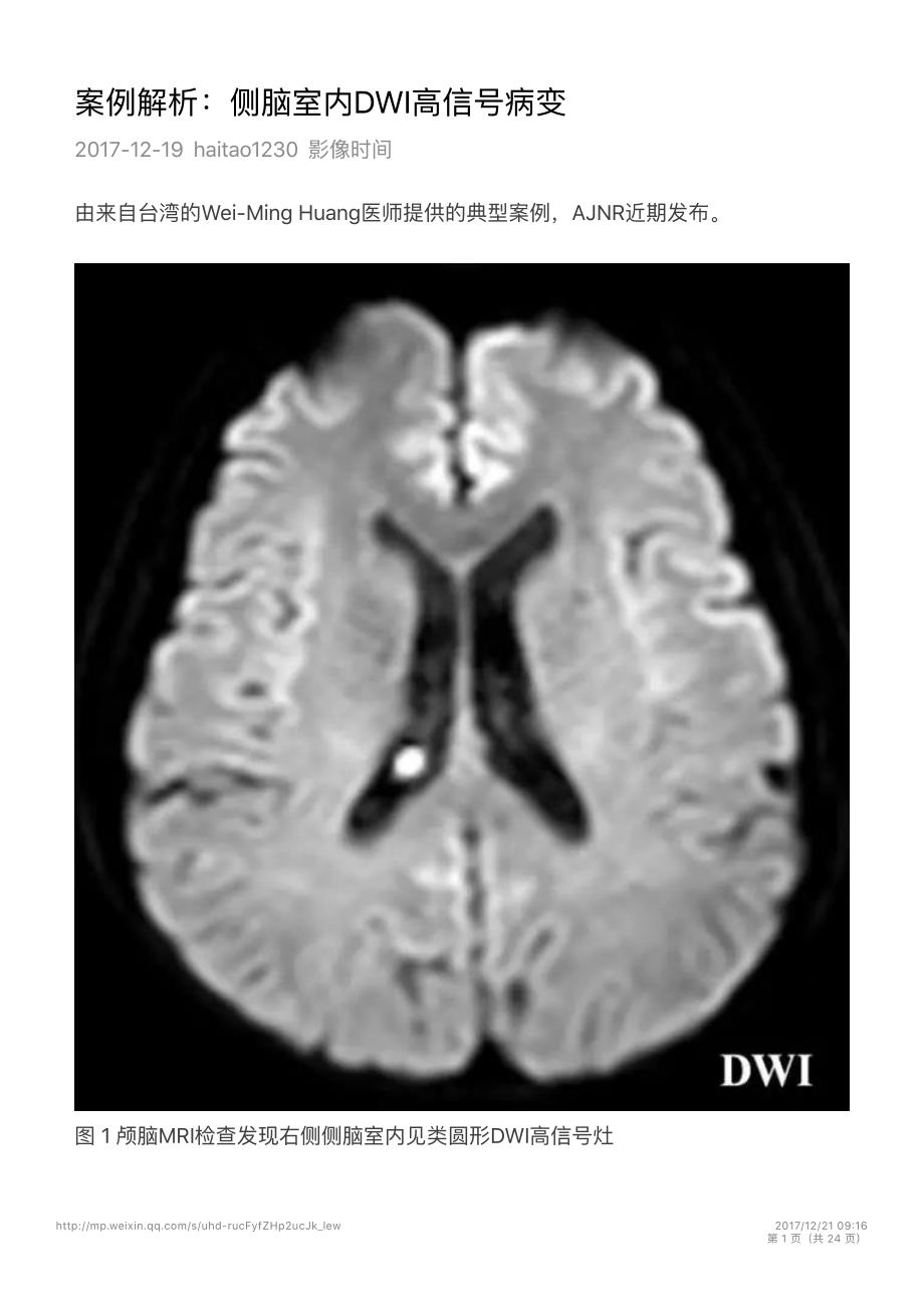 案例解析：侧脑室内DWI高信号病变_第1页