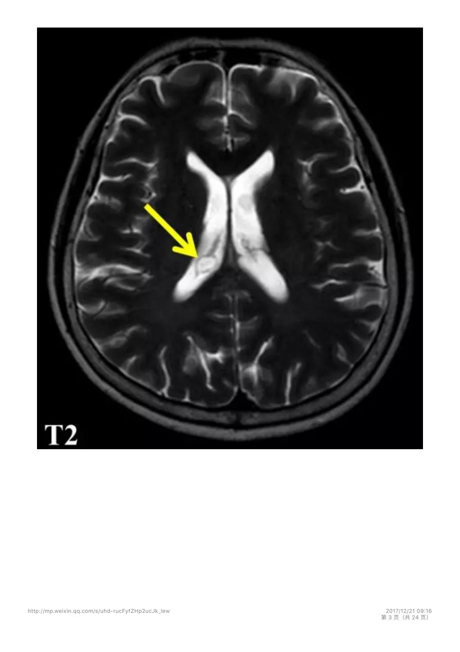 案例解析：侧脑室内DWI高信号病变_第3页