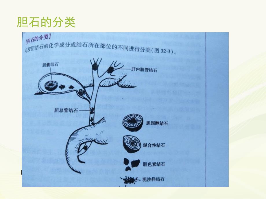 胆总管结石伴急性胆管炎_第4页