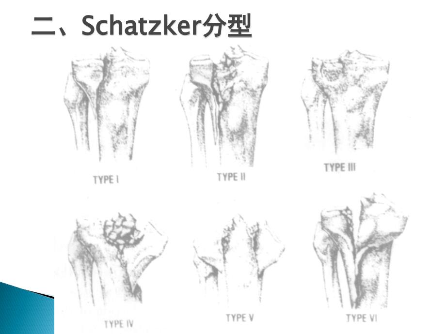 胫骨平台后侧柱骨折_第4页