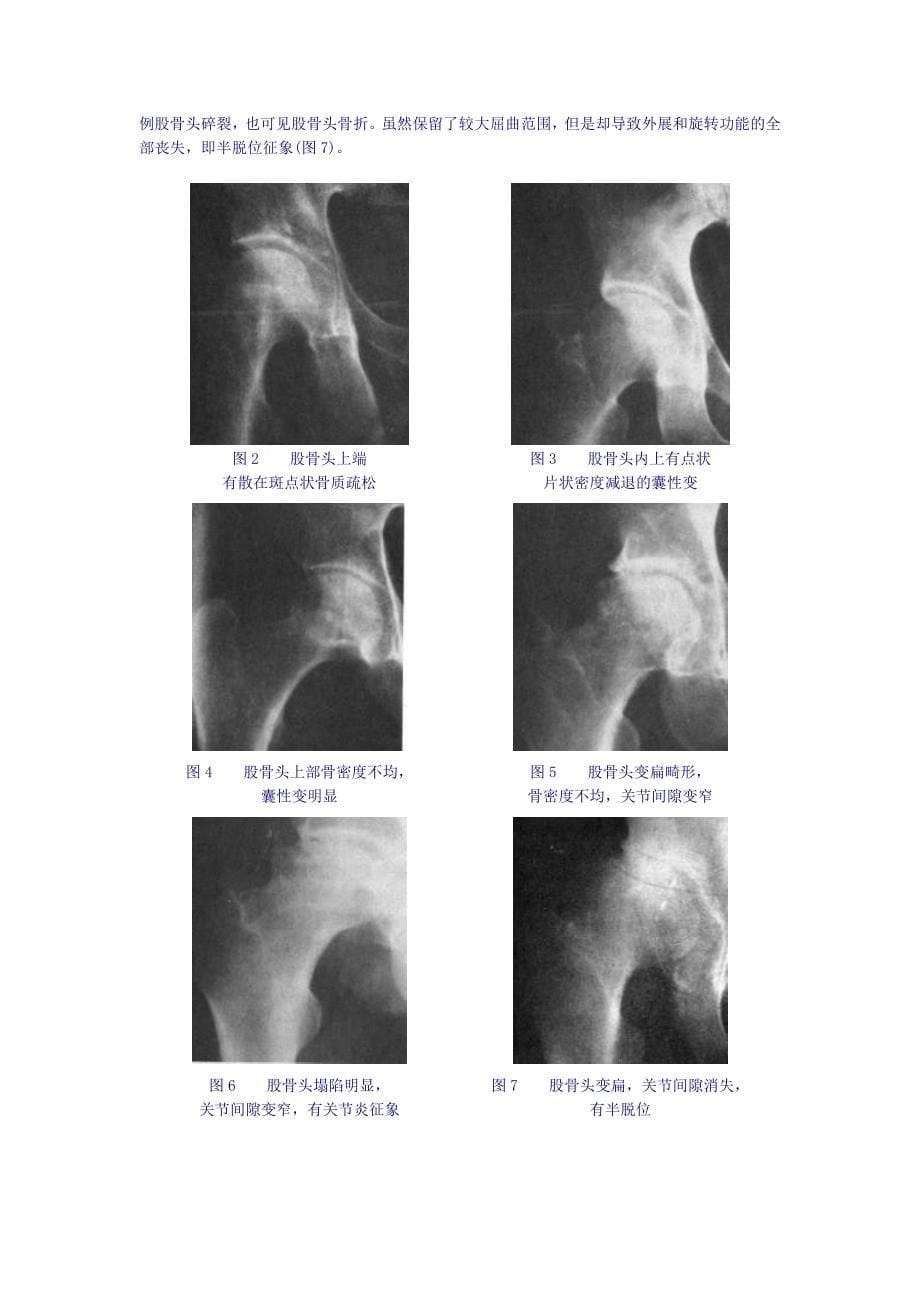 股骨头坏死的诊断要点及临床表现_第5页