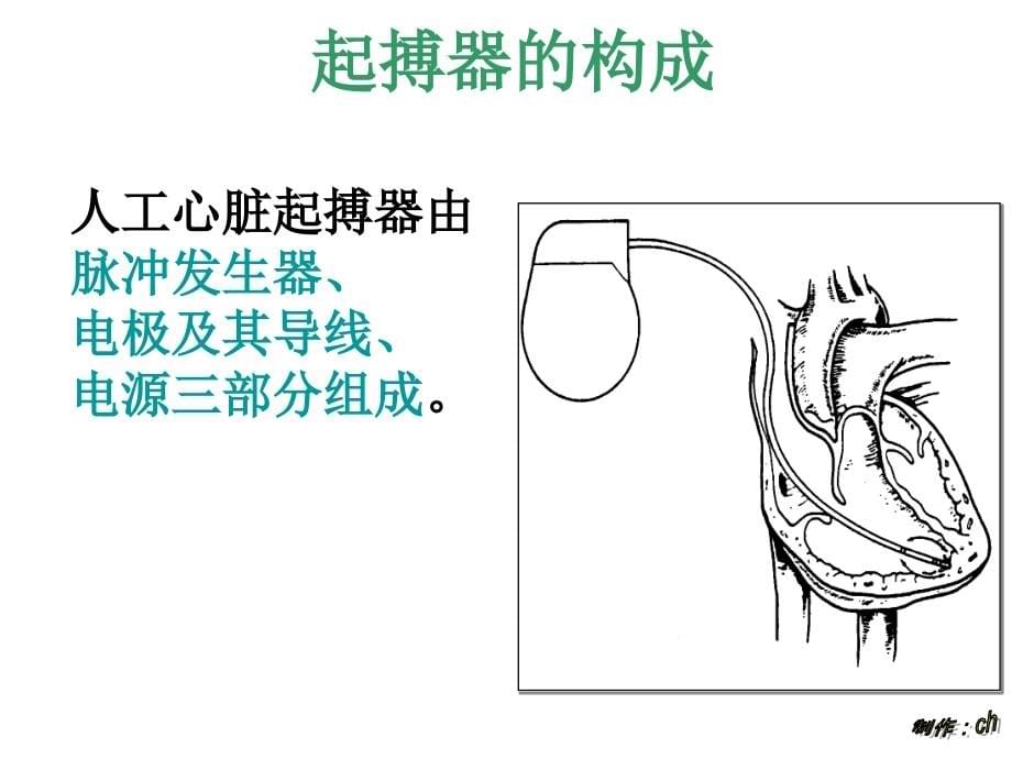 永久心脏起搏器的护理及心电图识别_第5页