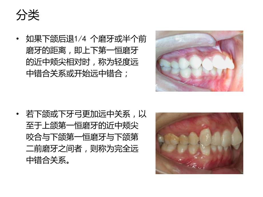 安氏ii类错合的矫治_第3页