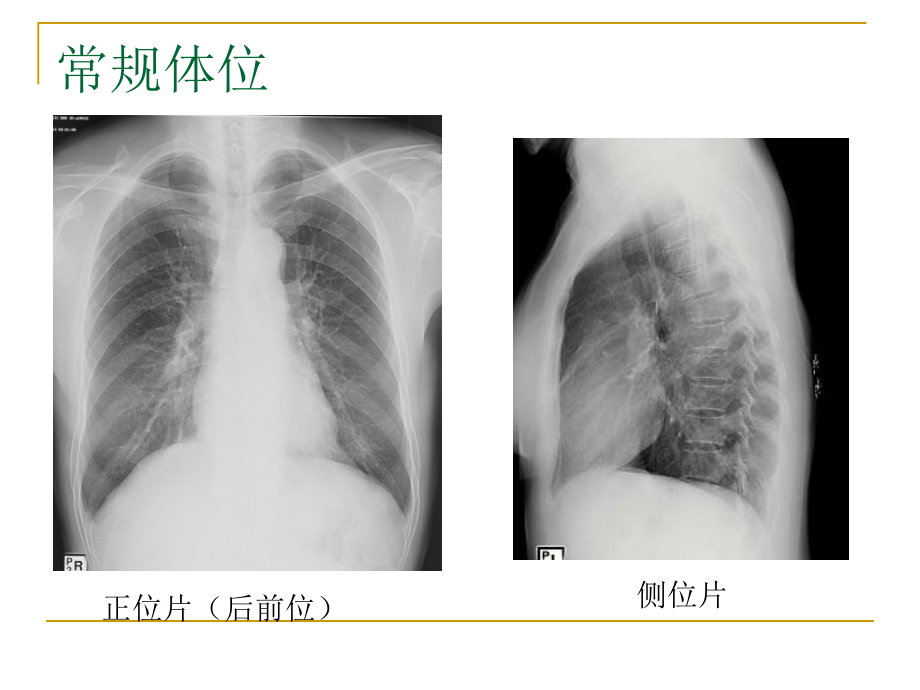 呼吸科X线、CT带教(正常、基本病变均包含)_第4页