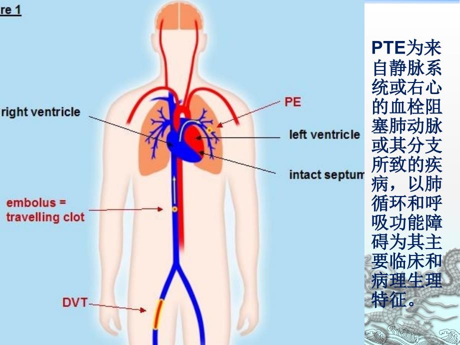 下肢深静脉血栓的护理_第3页