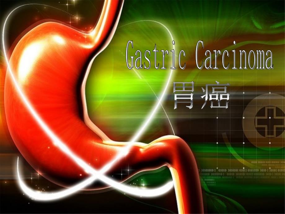 医学英语疾病介绍—GastricCarcinoma胃癌_第1页