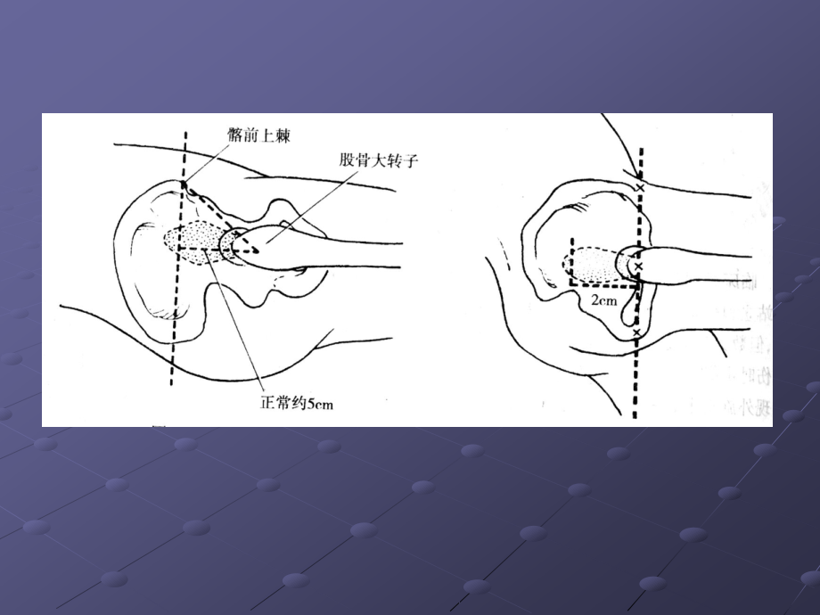 下肢骨折与关节脱位_第4页