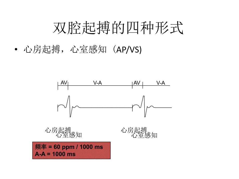 双腔起搏器技术及临床心电图表现要_第4页