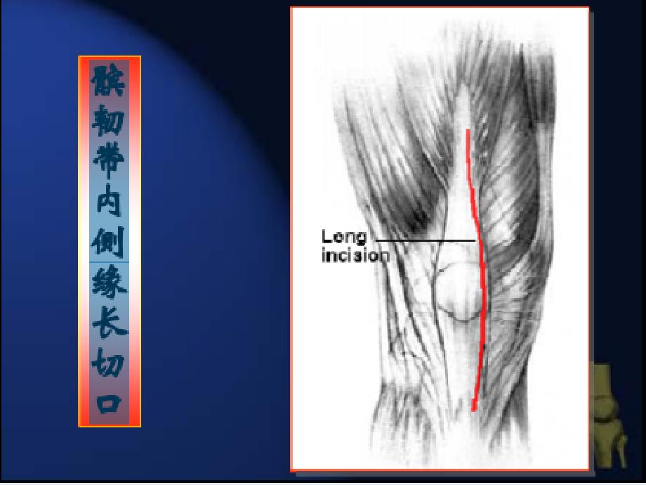 人工全膝关节置换术手术步骤_第4页