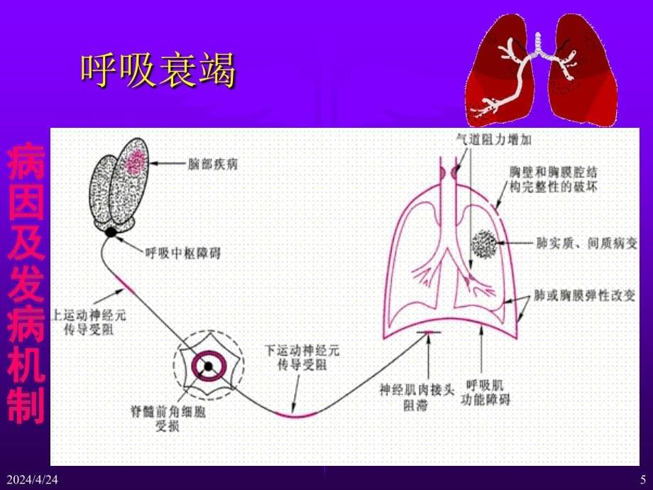 内科de呼吸衰竭_第5页