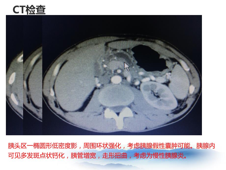 慢性胰腺炎的ERCP胰管支架植入术_第4页