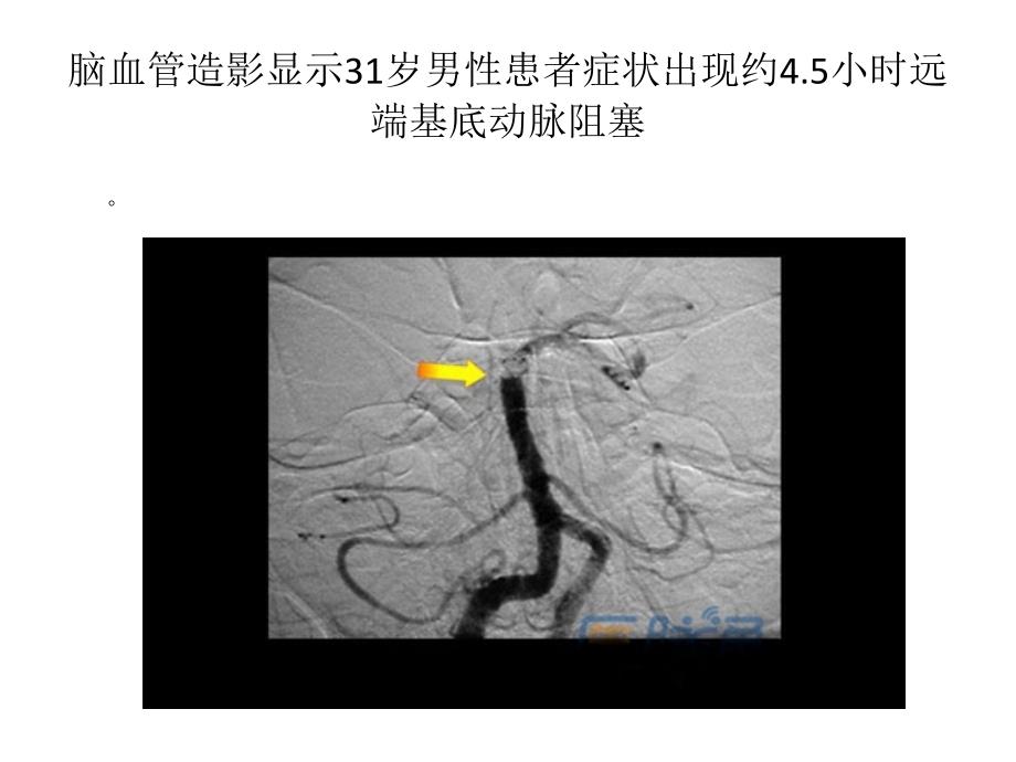 急性卒中早期影像学表现_第3页