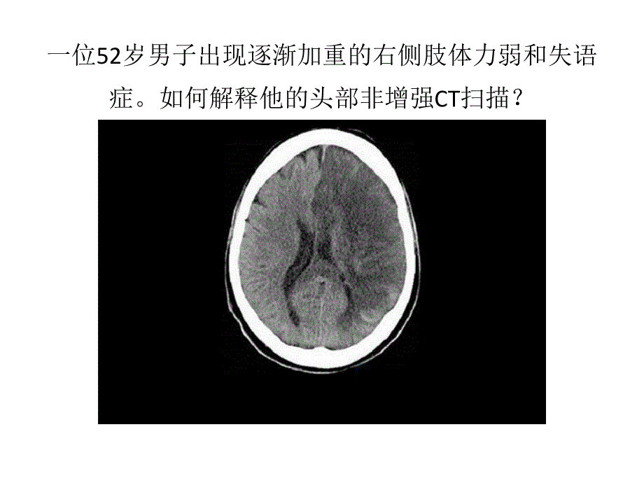 急性卒中早期影像学表现_第4页