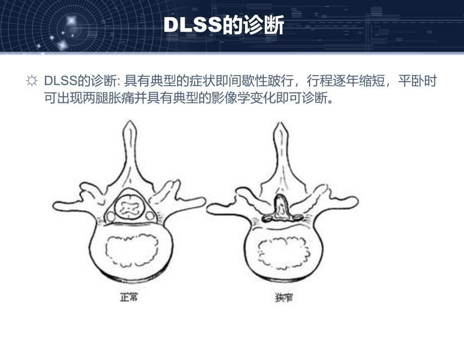 开窗减压术与全椎板切除减压术治疗中老年退行性腰椎管狭窄症的疗效比较开题报告_第5页