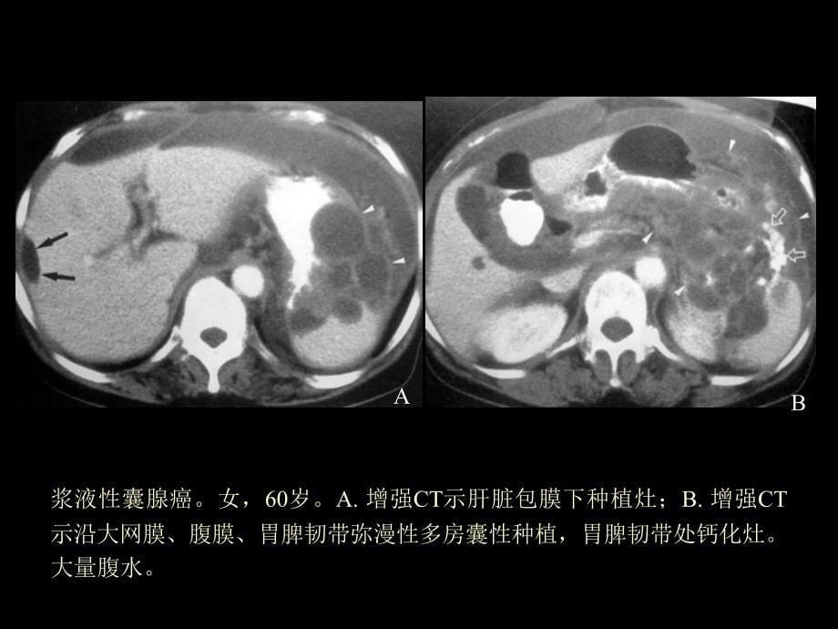 卵巢肿瘤的影像学表现及鉴别_第5页