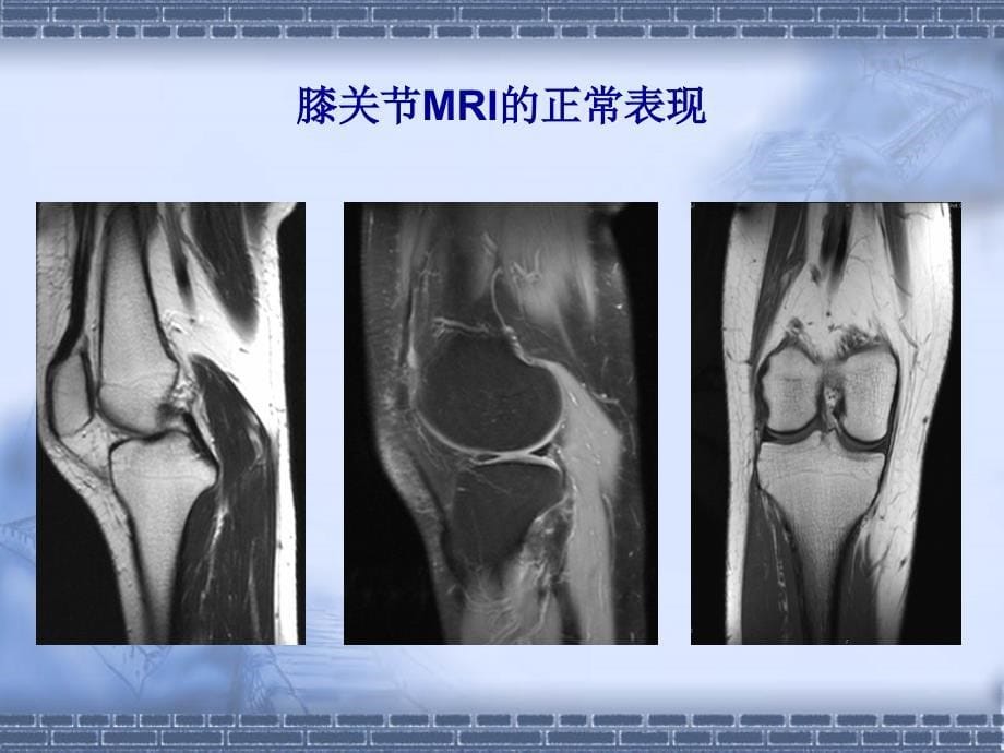 科普膝关节骨性关节炎的_第5页