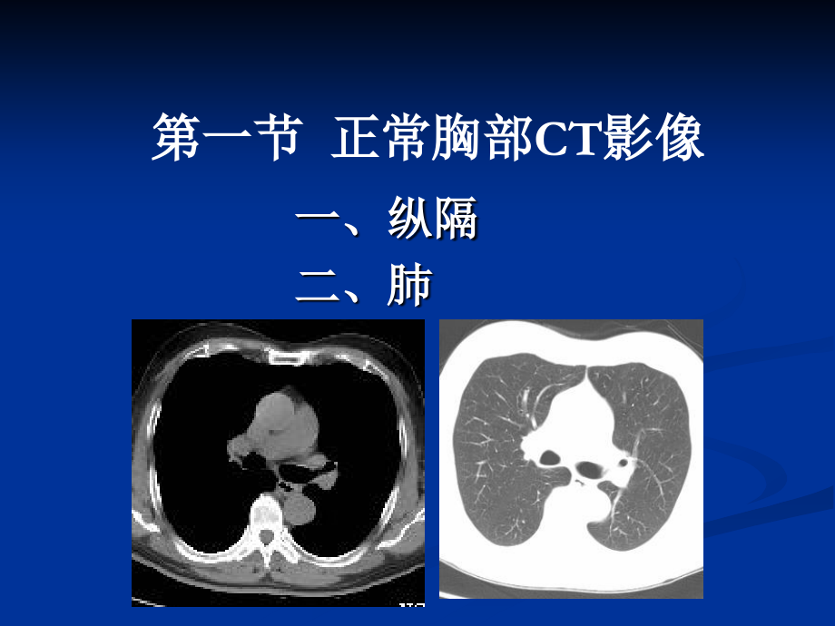 胸部常见疾病CT诊断与鉴别诊断_第2页