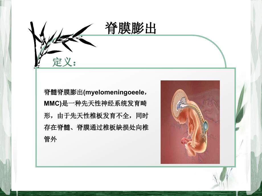 先天性脊髓脊膜膨出_基础医学_医药卫生_专业资料_第4页