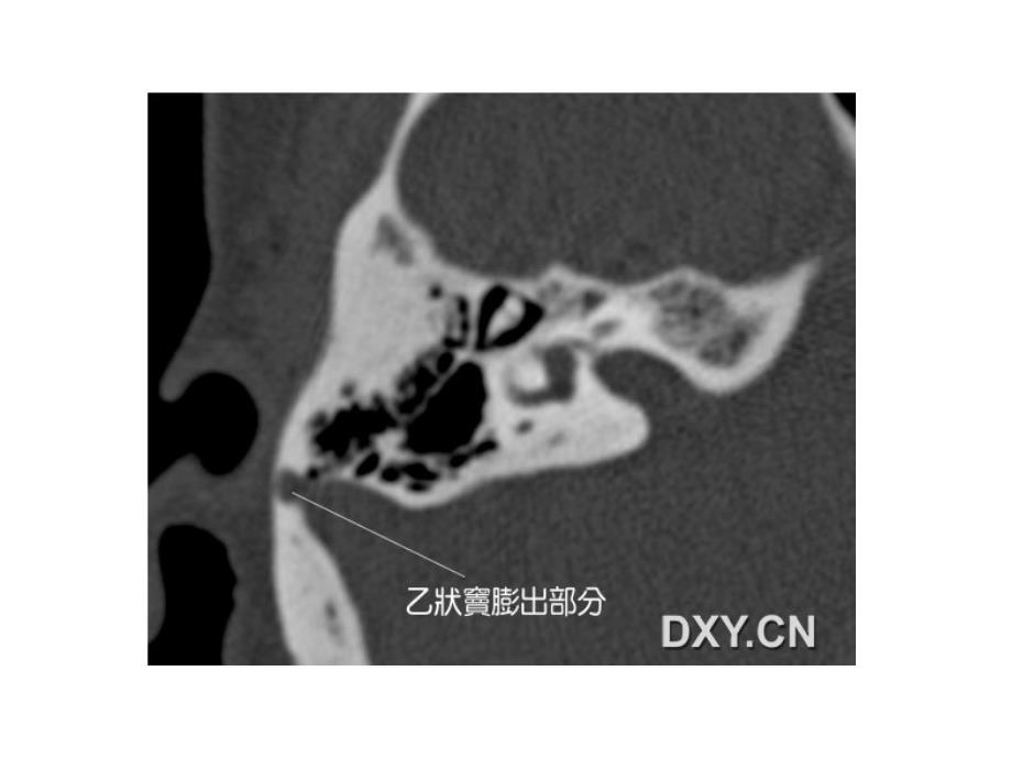 耳鸣与乙状窦憩室_第4页