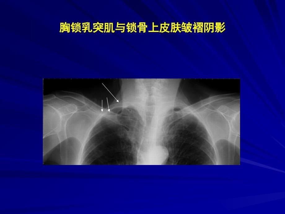 三基、规培考试全胸片的判读(最新)_第5页