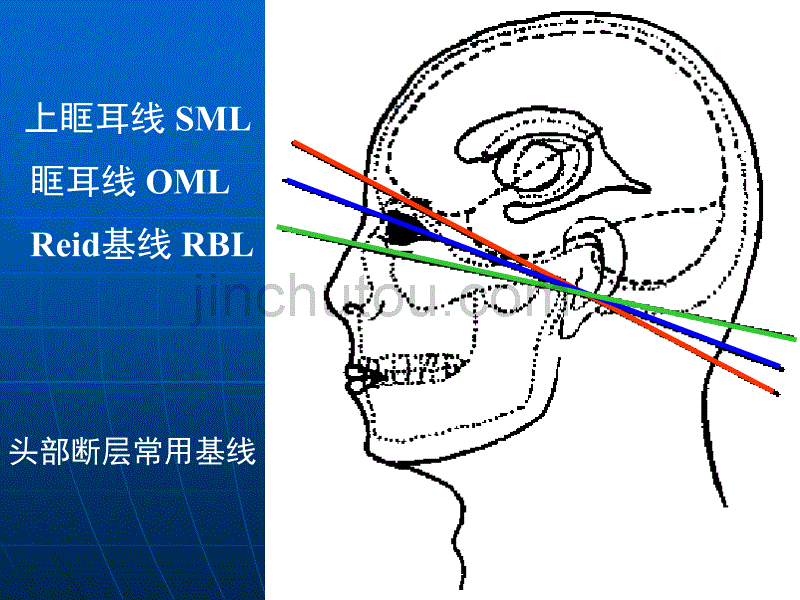 头颅横断层CT基本知识与常见疾病_第5页