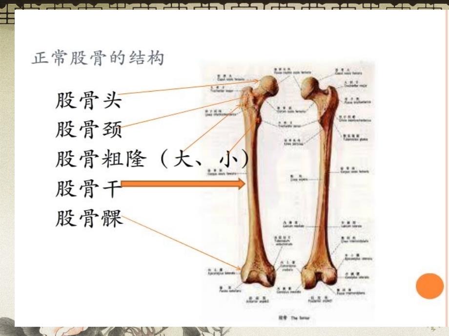 股骨干骨折护理修改后 课件_第3页