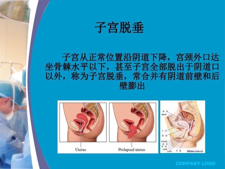 盆底重建围手术期的护理_第5页